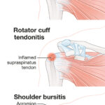 Can you bowl with a torn rotator cuff