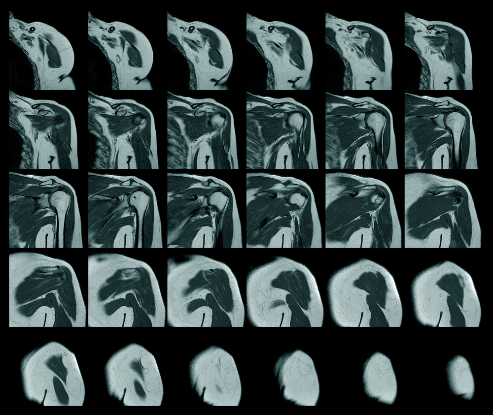 A magnetic resonance image of sore shoulder rotator cuff tear from fast swinging motions with a bowling ball.