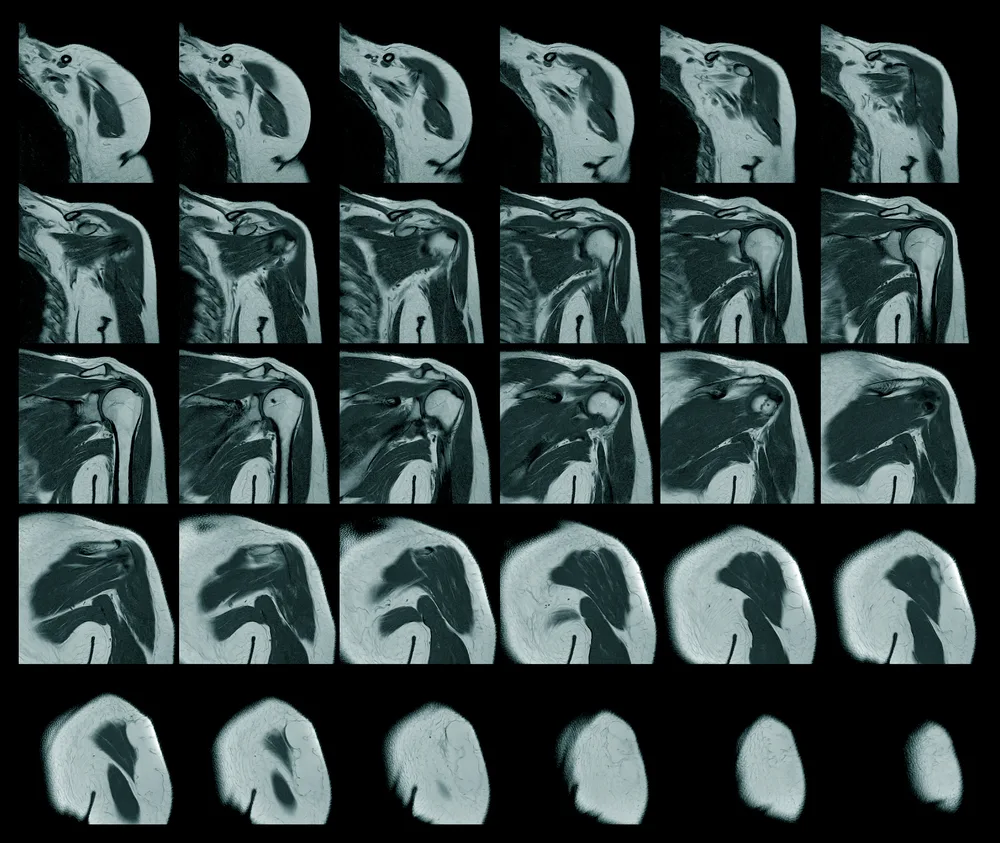 A magnetic resonance image of sore shoulder rotator cuff tear from fast swinging motions with a bowling ball.
