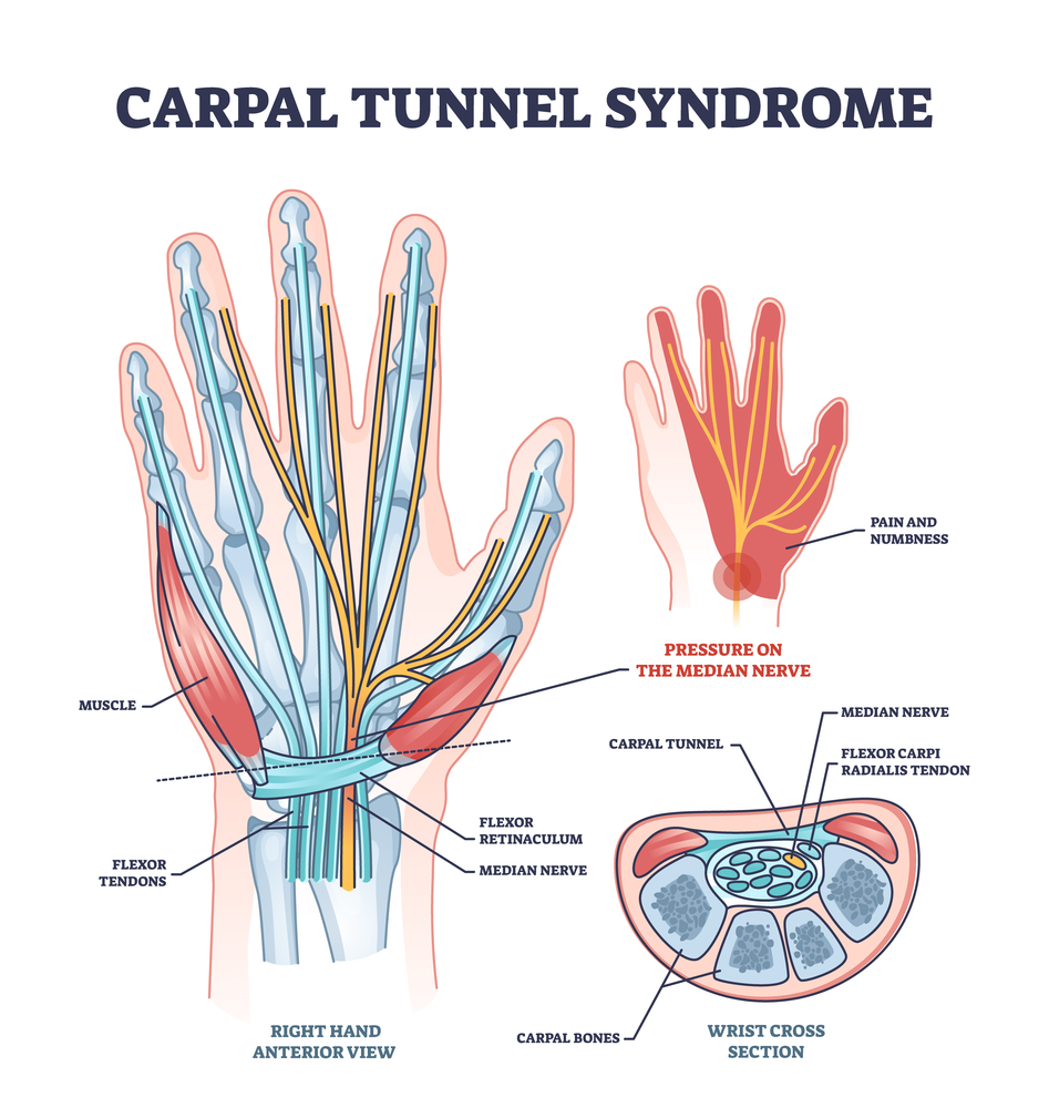 A detailed diagram is showing hand injuries and carpal tunnel syndrome with median nerve pressure disease.
