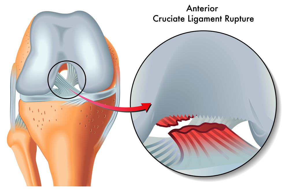 An infographic shows a painful knee joint tearing or an anterior cruciate ligament rupture.