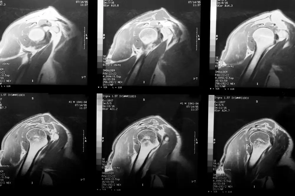 Mri images of shoulder muscles of the right shoulder (right arm) that can be injured with too much force.