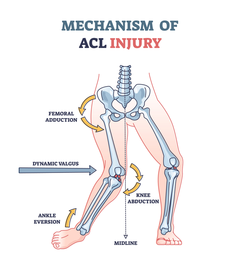 Diagram of an acl injury caused by excessive body weight putting pressure on the knee causing knee abduction.