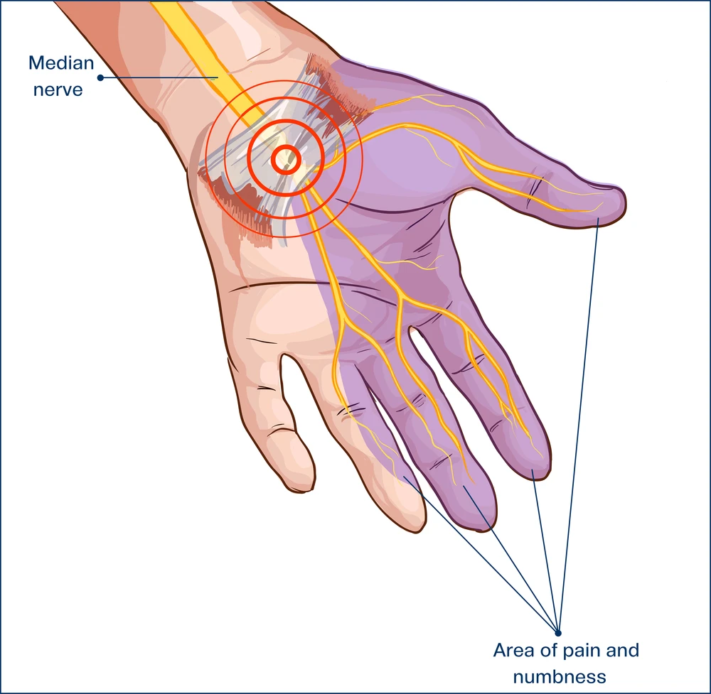 A hand showing the index finger and ring finger transverse carpal ligament compressed median nerve.