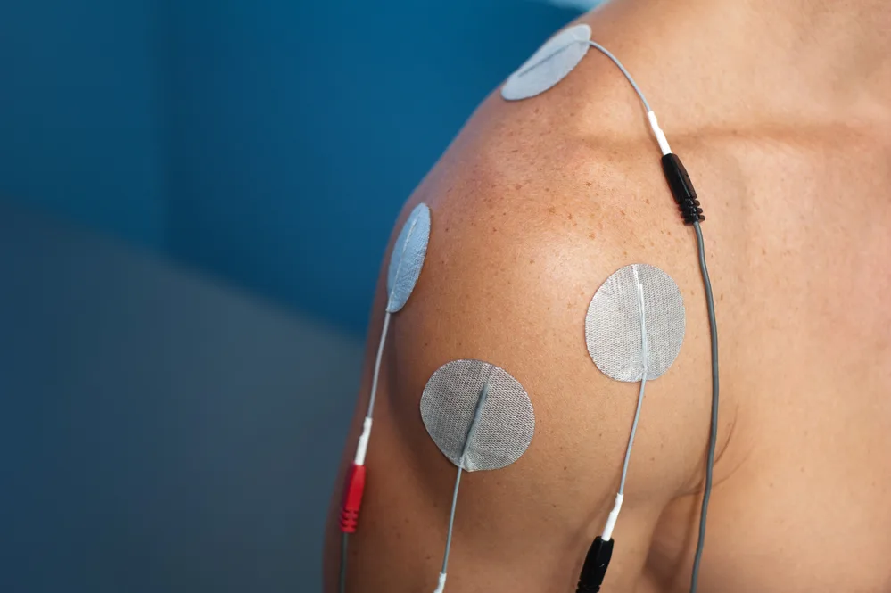 Physical therapy of a male patient's injured shoulder using transcutaneous interferential electrical stimulation (tens) for pain management.