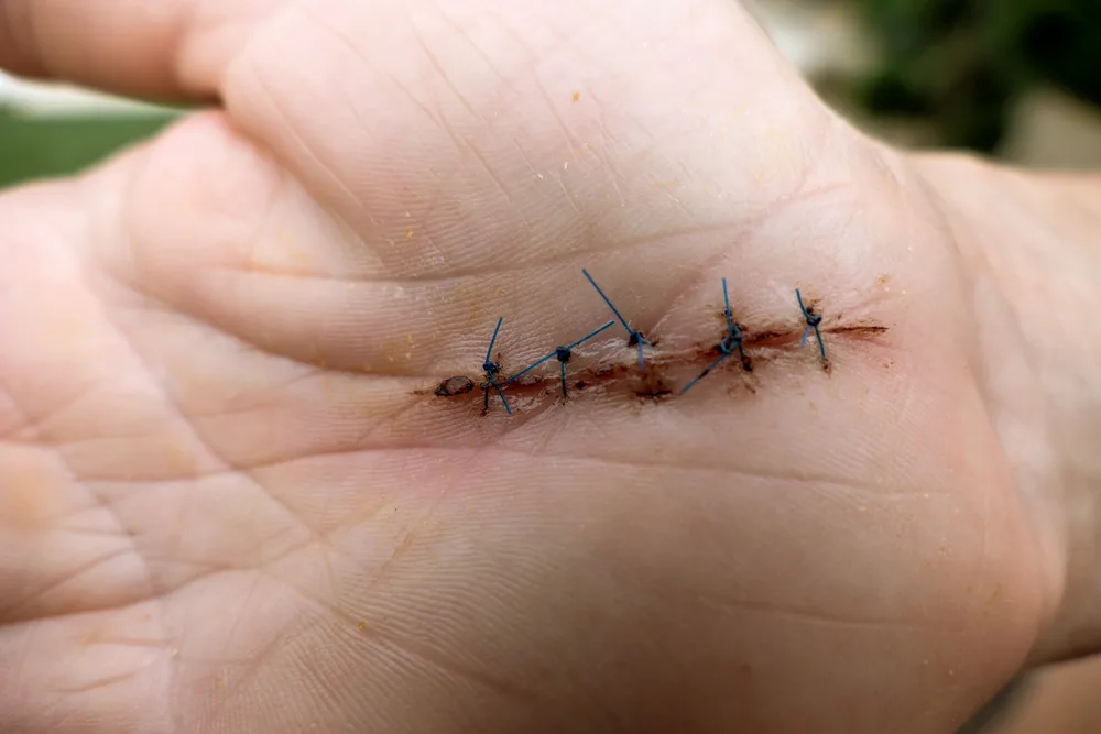 To prevent muscle fatigue after surgery, the stitches have to heal.