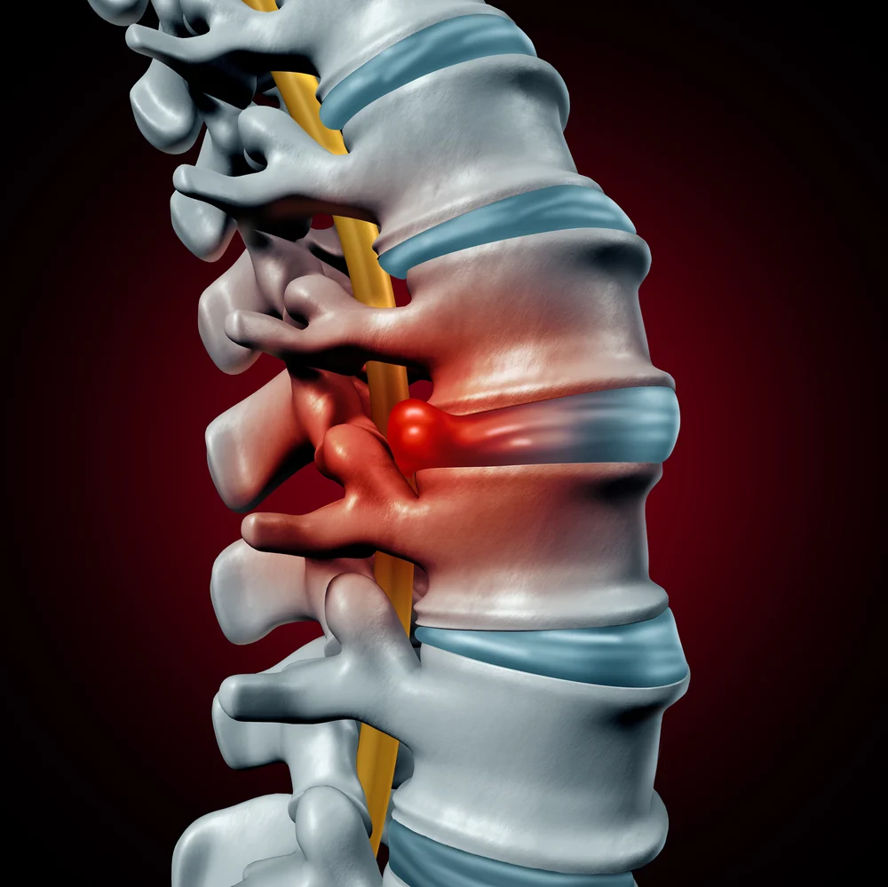 Image of a lumbar spine with inflammed spinal discs