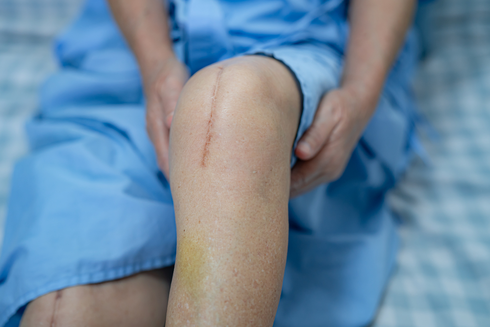 Woman patient shows her scars surgical total knee joint replacement suture wound surgery where her knee muscles were cut and knee implants inserted
